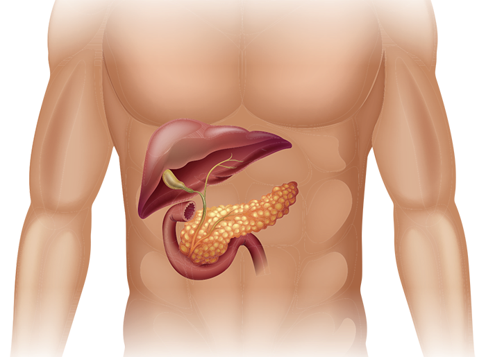 pancreatic cancer in body